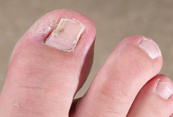 Formerly Ingrown Toenail Recovering Surgery Several Months Have Passed Surgical — Stock Photo, Image