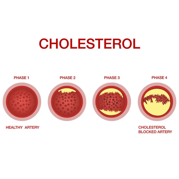 Colesterol en las arterias.La acumulación de colesterol en los vasos sanguíneos. Aterosclerosis — Vector de stock