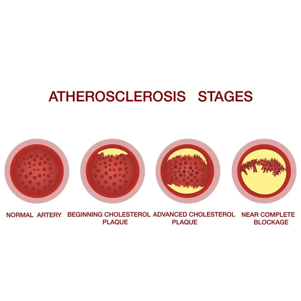 Ateroskleroz aşamaları. Kan damarlarında kolesterol birikmesi. Atherosclerosis