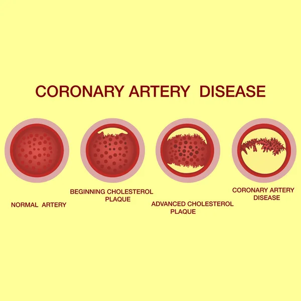 Coronary artery disease concept. Healthy and narrowed arteries with plaques — Stock Vector