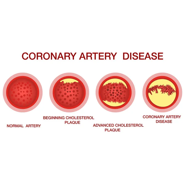 Konzept der koronaren Herzkrankheit. Gesunde und verengte Arterien mit Plaques — Stockvektor