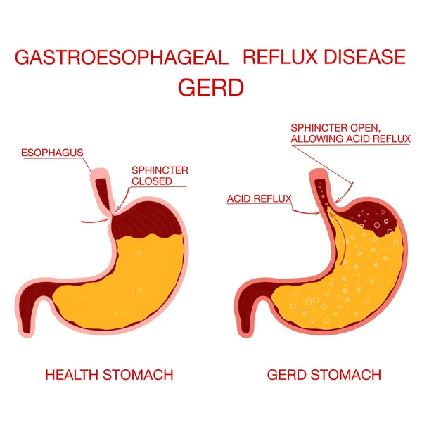 Heartburn and Gastroesophageal Reflux Disease GERD.Concept health (dalam bahasa Inggris). - Stok Vektor