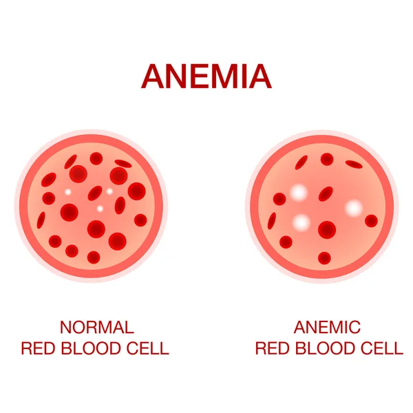 Imagen infográfica de la anemia. La diferencia de la cantidad de anemia de glóbulos rojos y normal — Vector de stock