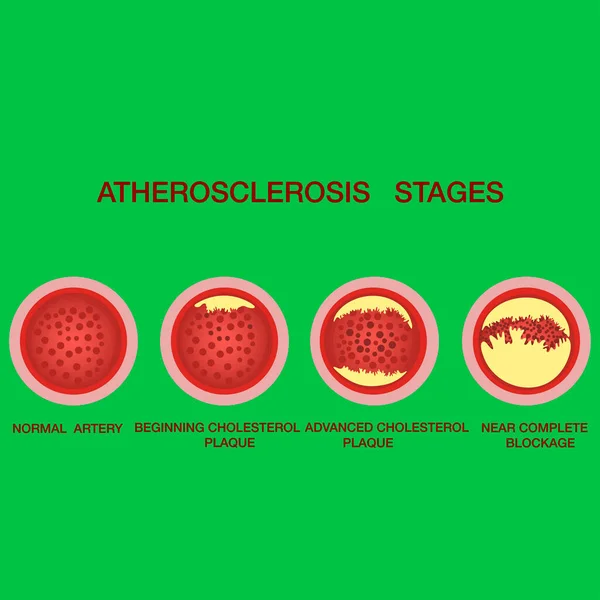 Atherosclerosis stages.The accumulation of cholesterol in the blood vessels. Atherosclerosis — Stock Vector