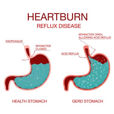 Heartburn Stomach disease.Indigestion and stomach pain problems.Human anatomy clipart