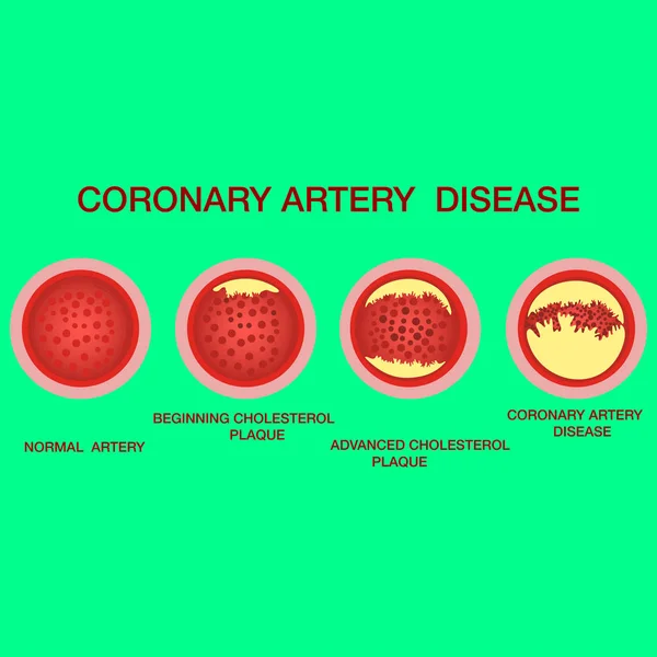 Concepto de enfermedad arterial coronaria. Arterias sanas y estrechas con placas — Archivo Imágenes Vectoriales