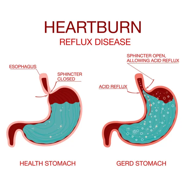 Heartburn Stomach disease.Indigestion and stomach pain problems.Human anatomy — Stock Vector