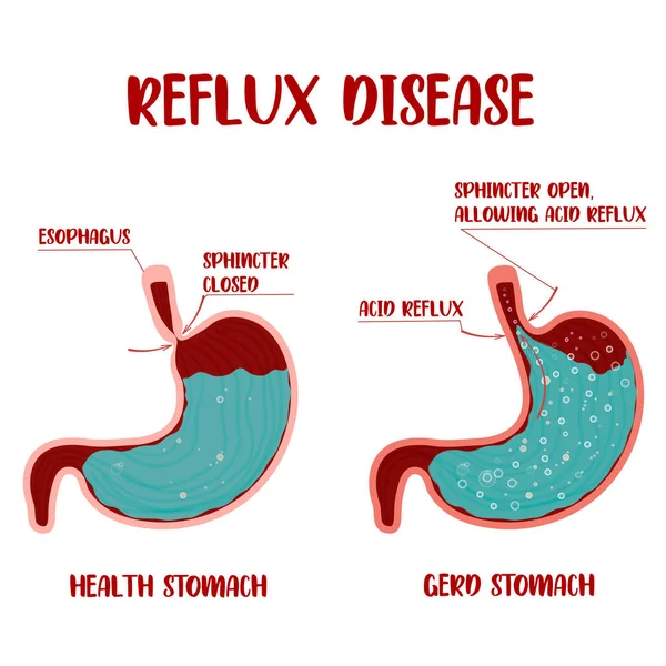 Mide yanması. Hazımsızlık ve mide ağrısı. İnsan anatomisi.