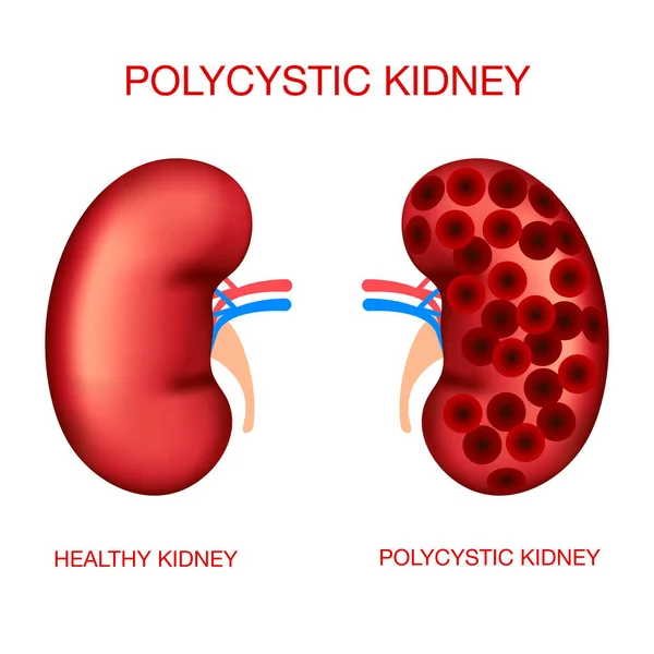 Polisistik böbrek hastalığı. Normal ve polisistik böbrekler. Gerçekçi organlar.