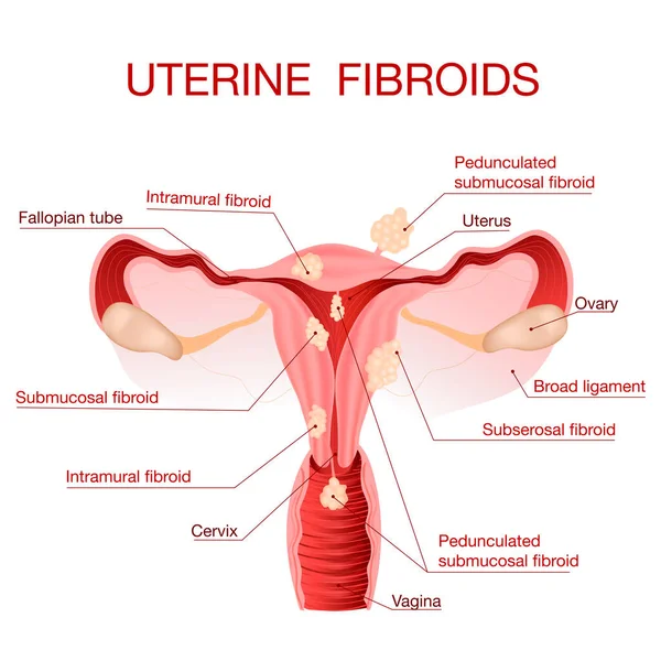 Vulvovaginal candidiasis eller vaginal jästinfektion.Vektorillustration — Stock vektor