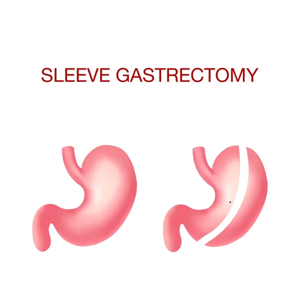 Gastrectomía de manga vertical. Cirugía de pérdida de peso .Anatomical . — Archivo Imágenes Vectoriales