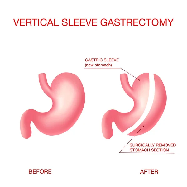 Gastrectomía de manga vertical. Cirugía de pérdida de peso .Anatomical . — Vector de stock
