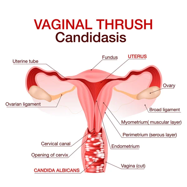 Candidiasis vulvovaginal o infección por hongos vaginales.Ilustración vectorial — Vector de stock