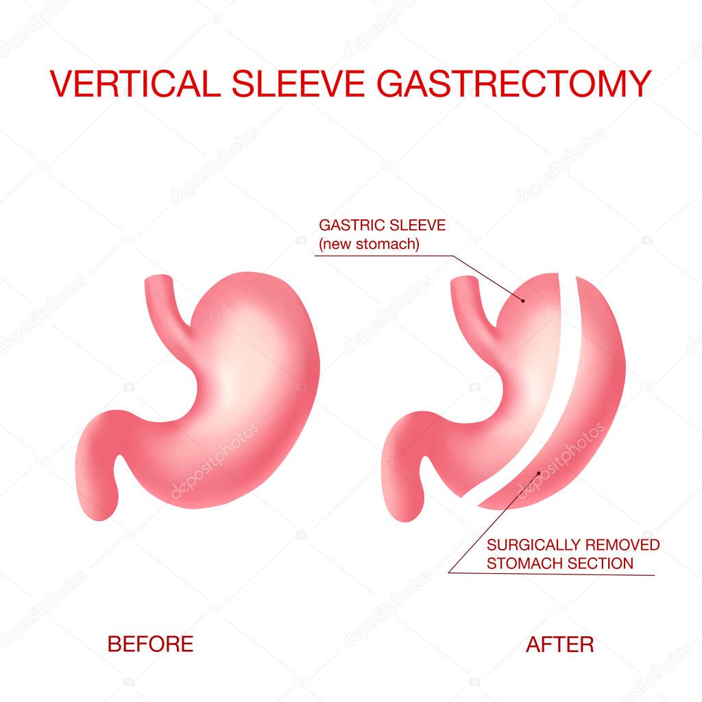 Vertical Sleeve Gastrectomy. Weight Loss Surgery .Anatomical.