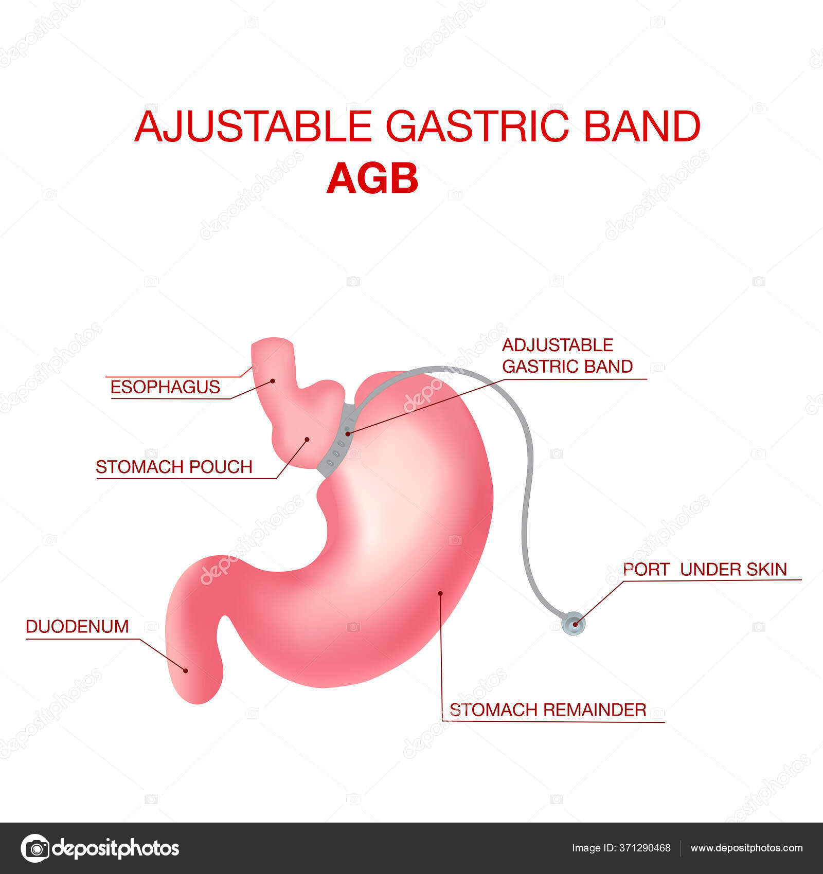 Gastric Band Weight Loss Surgery.Band with a Port that Under the Skin Stock Vector Image by