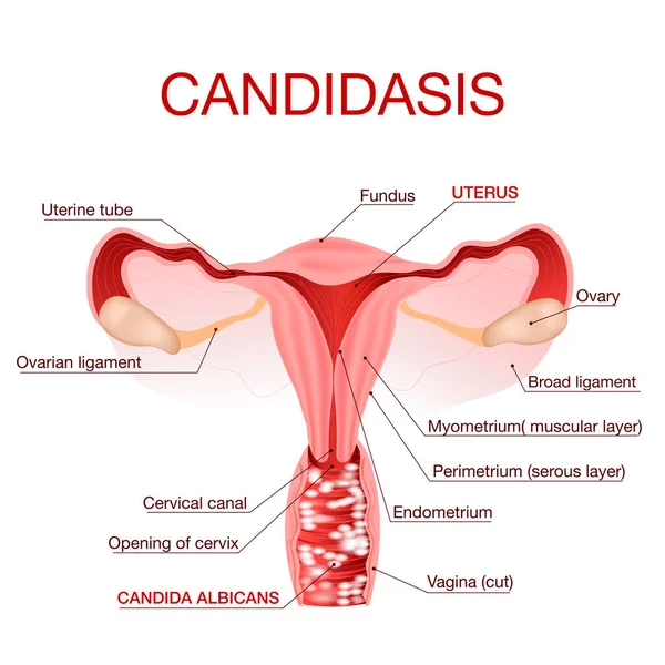 Candidiasis vulvovaginal o infección por hongos vaginales.Ilustración vectorial — Vector de stock