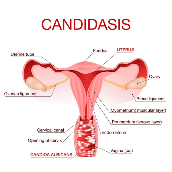 Vulvovaginale Candidiasis oder vaginale Hefeinfektion. Vektorillustration — Stockvektor