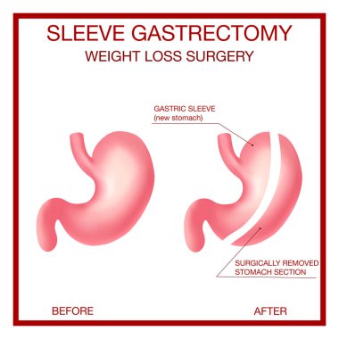 Dikey Kollu Gastrectomy. Kilo kaybı ameliyatı. Anatomik..