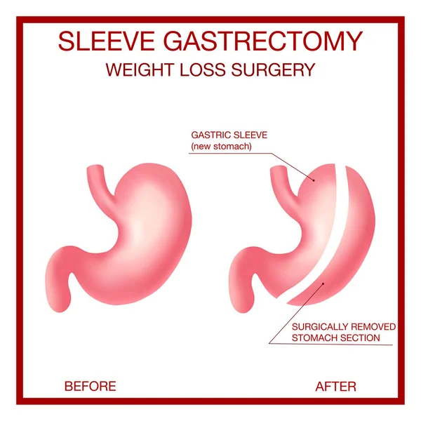 Vertikalhülsen-Gastrektomie. Gewichtsverlust-Chirurgie. Anatomische. — Stockvektor