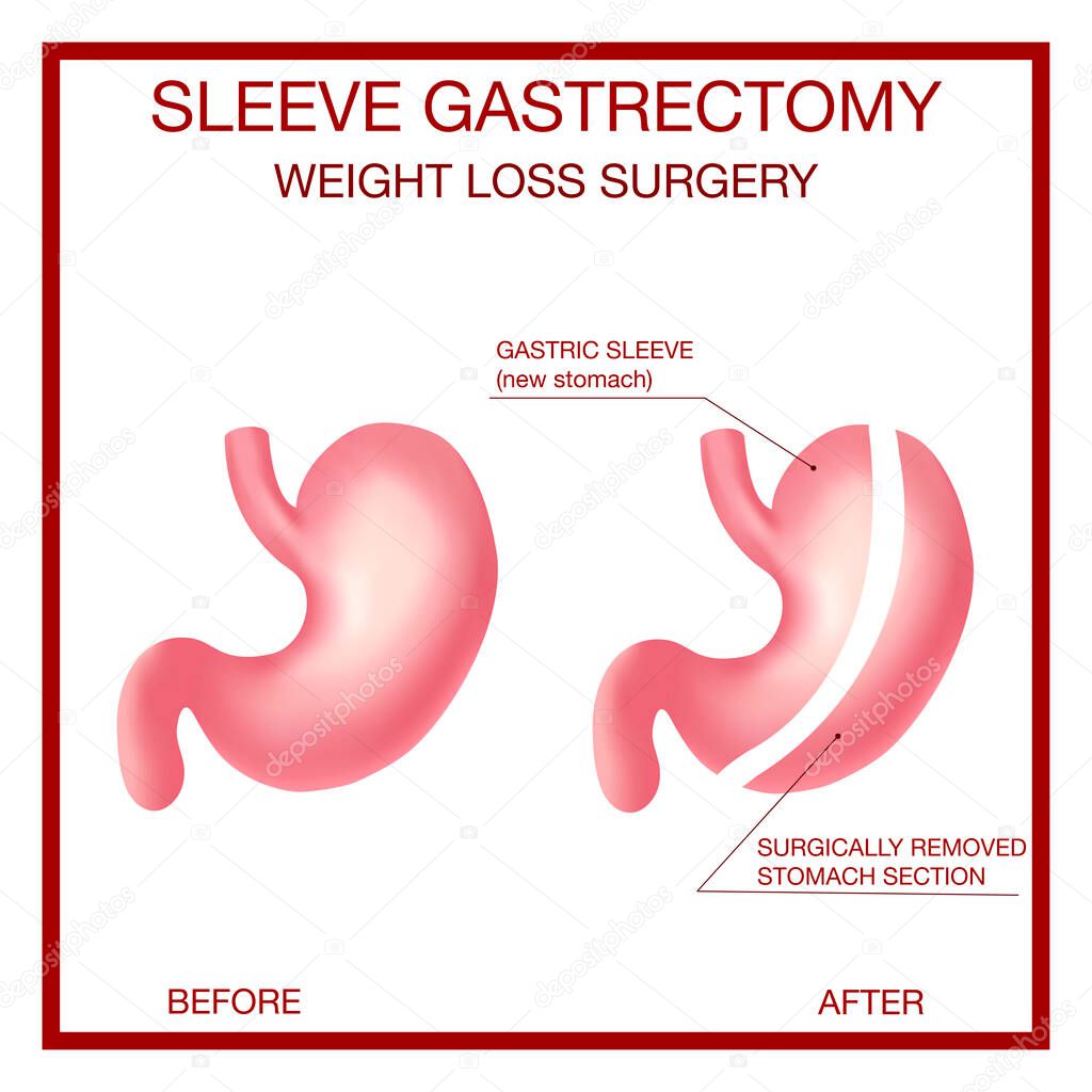 Vertical Sleeve Gastrectomy. Weight Loss Surgery .Anatomical.