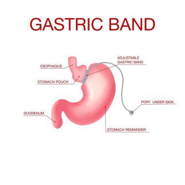 Gastrik Band Kilo Verme Ameliyatı. Derinin Altında Porto Rıhtımı olan bir grup.