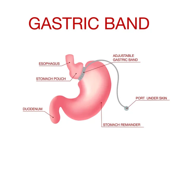 Gastric Band Weight Loss Surgery.Band med en port som under huden — Stock vektor