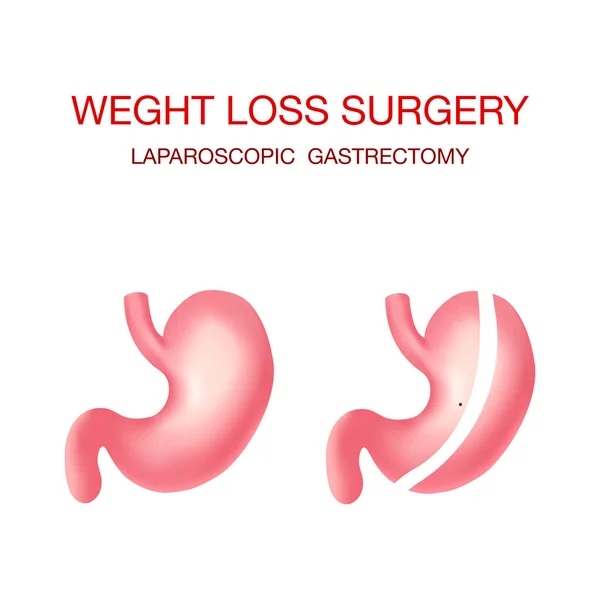 Gastrectomia vertical de manga. Cirurgia da perda de peso .Anatomical . —  Vetores de Stock