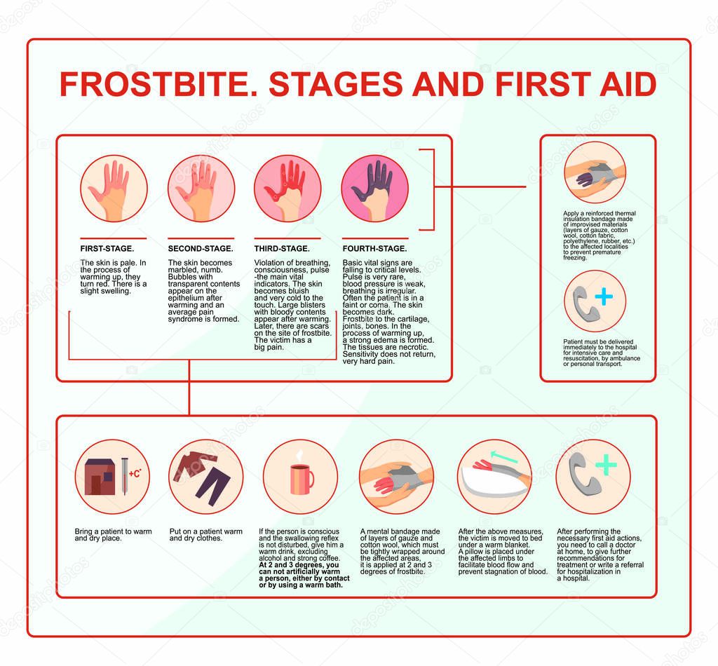 Frostbite - symptoms, protection and treatment. infographics illustration in vector. First aid while hypothermia.