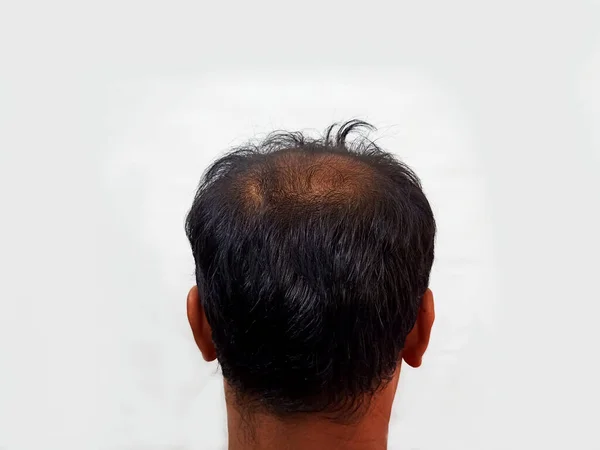 Captura Perto Cabeça Homem Com Sintomas Perda Cabelo Homem Meia — Fotografia de Stock