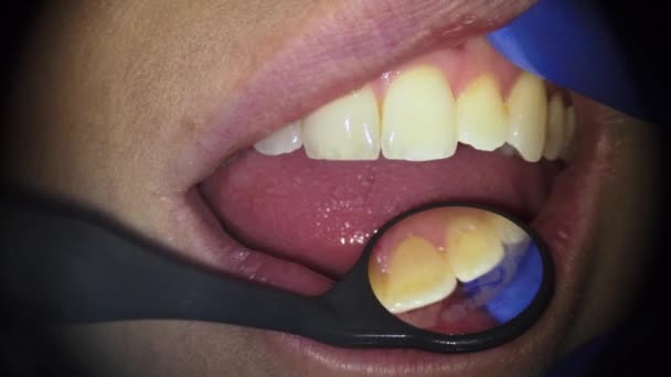 Dentist Examining Patients Teeth Angled Mirror — Stock Video