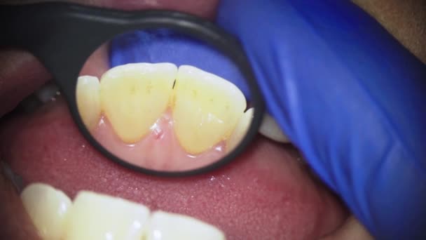 Dentist Examining Patients Teeth Angled Mirror — Stock Video