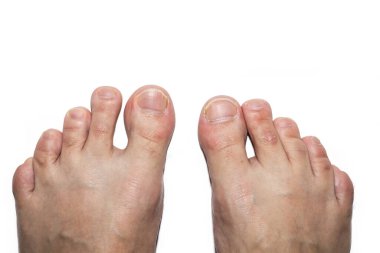 Beyaz arka planda pedikür olmayan erkek ayak parmakları. Manikür. Manikür. Spa salonu. İyi bakımlı tırnaklar değil. Kötü manikür. beyaz üzerine izole.