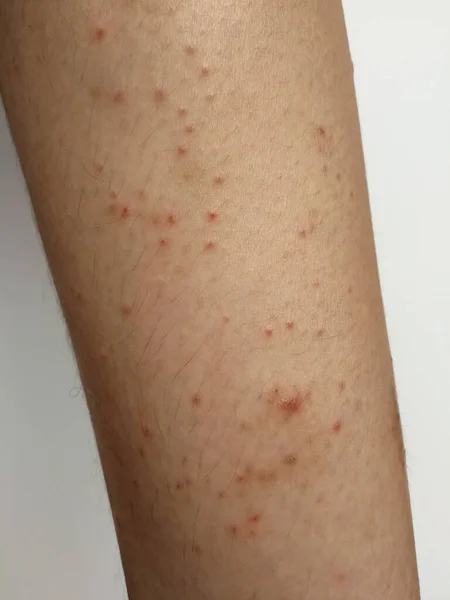 Niño Tiene Erupción Crónica Piel Hierba Alérgica Enfermedad Piel Dermatitis — Foto de Stock