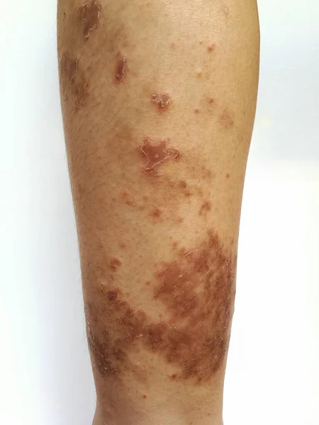 Niño Tiene Erupción Crónica Piel Hierba Alérgica Enfermedad Piel Dermatitis — Foto de Stock