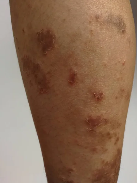 Niño Tiene Erupción Crónica Piel Hierba Alérgica Enfermedad Piel Dermatitis — Foto de Stock