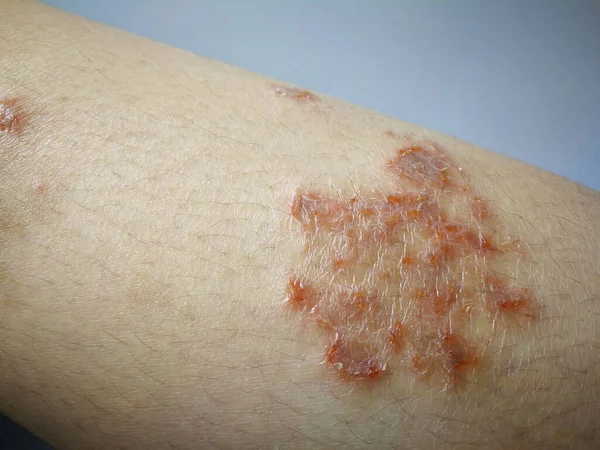 Niño Tiene Erupción Crónica Piel Hierba Alérgica Enfermedad Piel Dermatitis — Foto de Stock