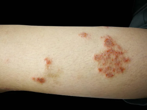 Niño Tiene Erupción Crónica Piel Hierba Alérgica Enfermedad Piel Dermatitis — Foto de Stock