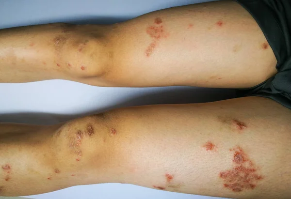 Niño Tiene Erupción Crónica Piel Hierba Alérgica Enfermedad Piel Dermatitis — Foto de Stock