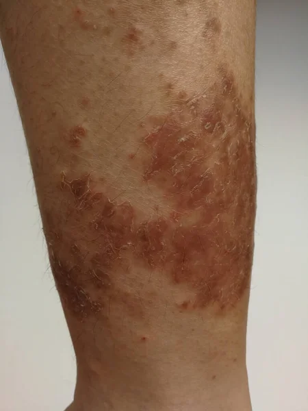 Young Boy Has Chronic Rash On Skin Grass Allergic Skin Disease Atopic Dermatitis Age Spot Skin Urticaria Sickness Stock Photo