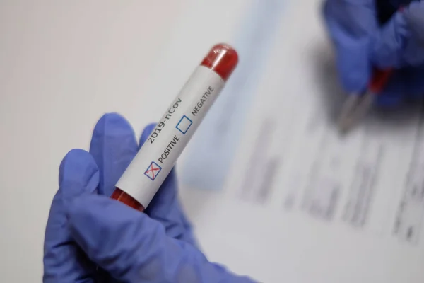 Coronavirus 2019-nCoV Blood Test.Corona virus. China virus. Coronavirus testing. The hand holds a test tube containing a patients sample that has tested positive on my sample coronavirus test form.