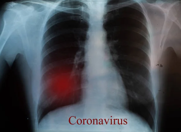 Radiografia Plămânilor Inflamație Textul Roșu Inscripționat Coronavirus Pandemie Coronavirus Conceptul — Fotografie, imagine de stoc