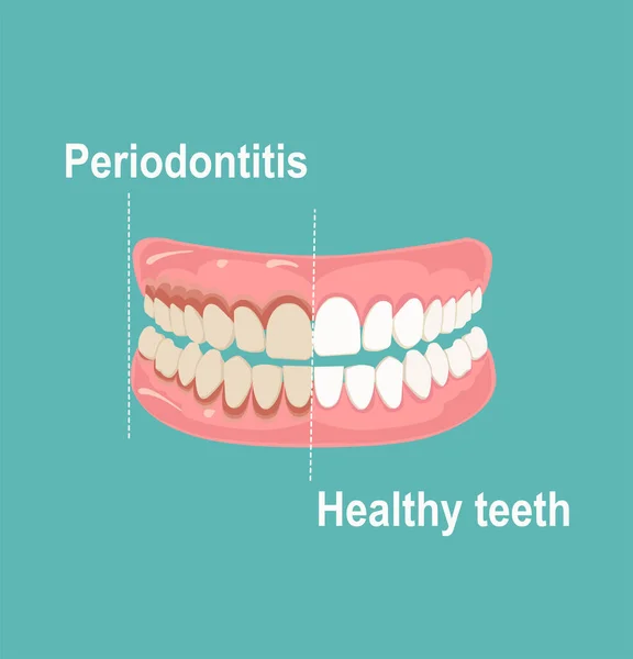 人类牙齿和牙龈的载体 健康且受牙周炎影响 — 图库矢量图片