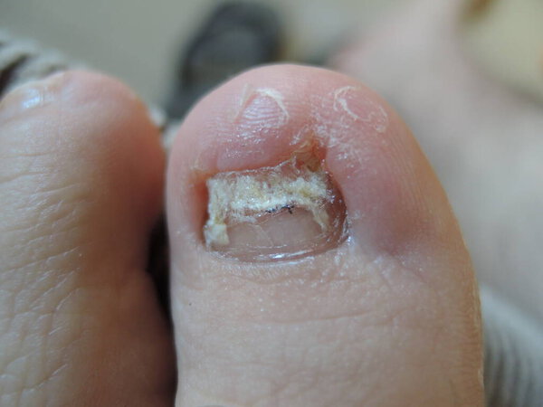 A toe nail with Onychomycosis, also reffered as tinea unguium, a fungal infection. Image showing how it can affect toes nails