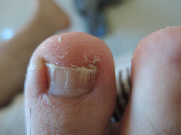 A toe nail with Onychomycosis, also reffered as tinea unguium, a fungal infection. Image showing how it can affect toes nails