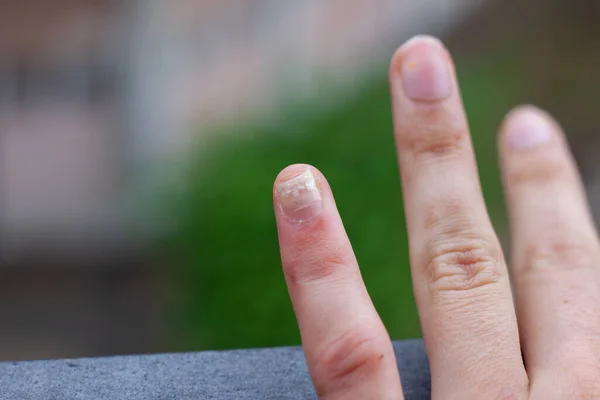 Close Female Hand Dirty Nail — Stock Photo, Image