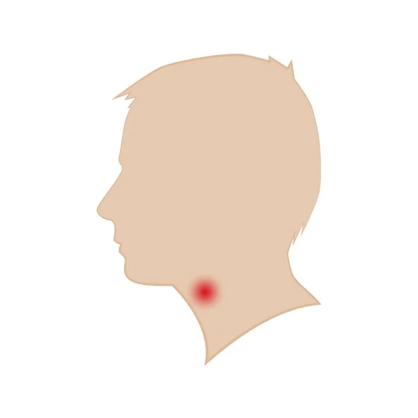 一个男人的头像剪影。咽喉疾病。矢量. — 图库矢量图片