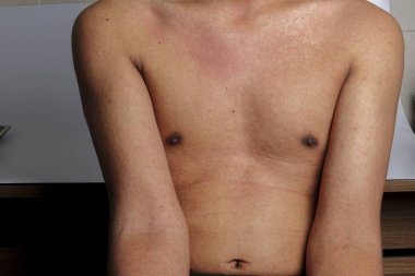 Döküntü, Anti döküntü Dermatit sorunu olan adam