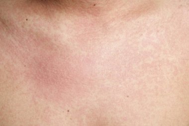 Döküntü, Anti döküntü Dermatit sorunu olan adam