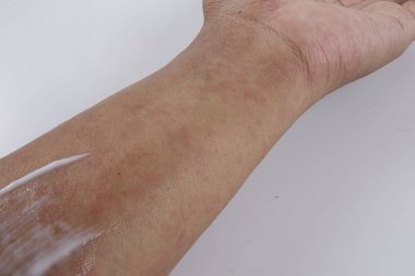 Döküntü, Anti döküntü Dermatit sorunu olan adam