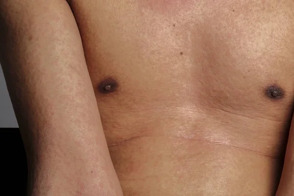 Homem com dermatite problema de erupção cutânea, erupção cutânea alérgica — Fotografia de Stock